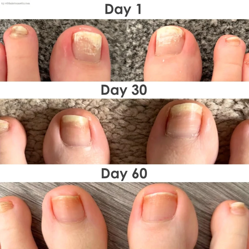 Fungal Freedom nail oil